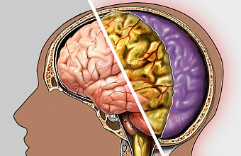 В России с начала 2025 года зафиксировано около 1200 случаев заболевания менингитом