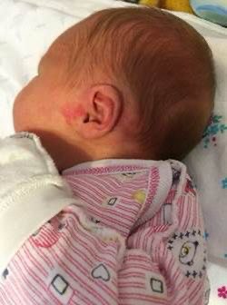 Младенческая гемангиома: риски, лечение и мнение врачей