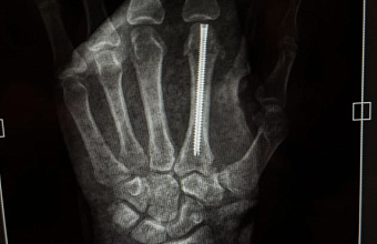 Умару Нурмагомедову прооперировали сломанный палец руки